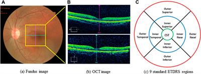 Thickened Retinal Nerve Fiber Layers Associated With High-Altitude Headache